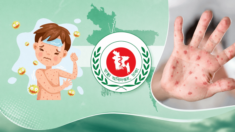 ২৪ ঘণ্টায় হাম ও উপসর্গে ৫ শিশুর মৃত্যু, আক্রান্ত ১ হাজার ২৫