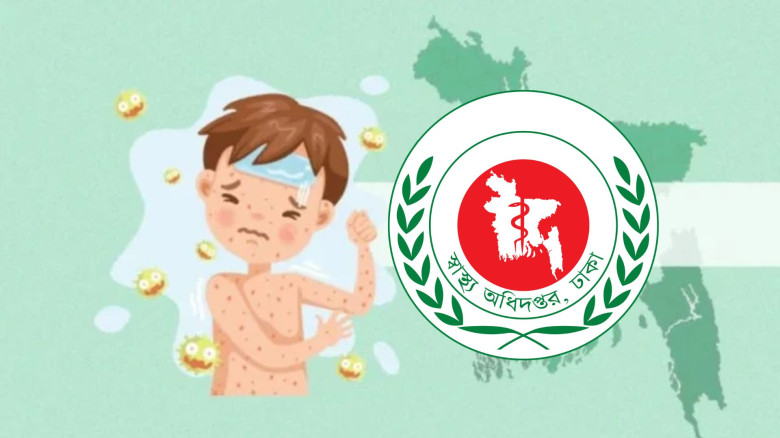 হামের উপসর্গ নিয়ে আরও ৬ শিশুর মৃত্যু, মোট মৃত্যু ৫৯৪